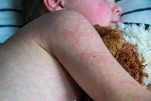 Understanding Measles: A Guide for Parents