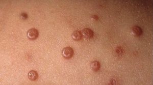 Molluscum Contagiosum in Children: The Common Skin Bumps That Look Worse Than They Are